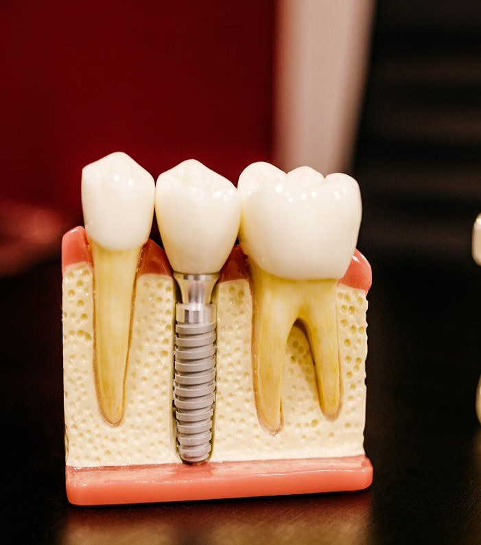 Dental Implants