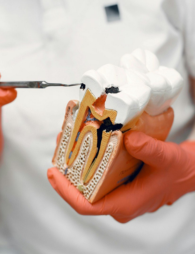 Root Canal Treatments Christchurch