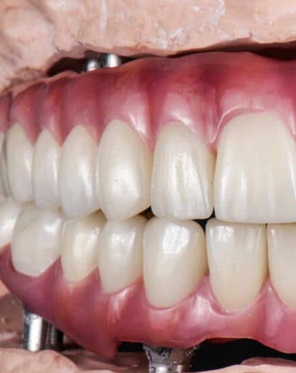 Best dental implant dentist Christchurch