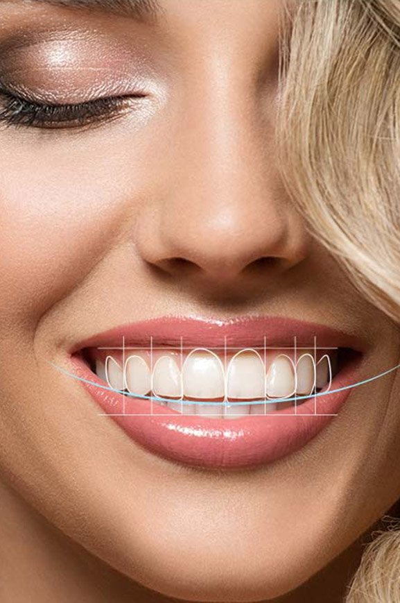 Best porcelain veneer dentist Christchurch Best porcelain veneer dentist Christchurch