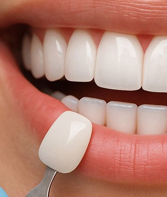 Natural looking porcelain veneers Christchurch Natural looking porcelain veneers Christchurch