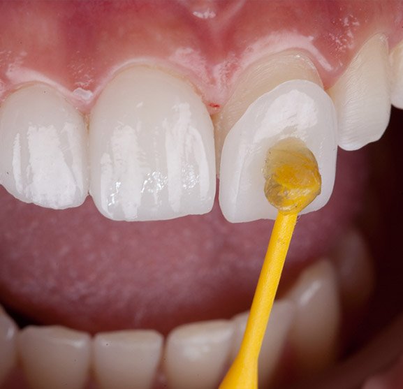 Porcelain veneers treatment Christchurch clinic Porcelain veneers treatment Christchurch clinic