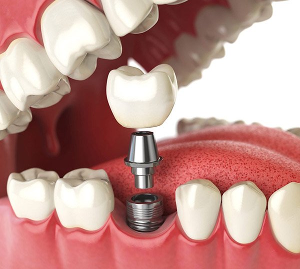 Professional dental implant services Christchurch