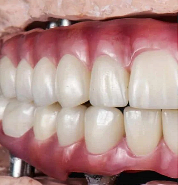 dental implants Edgeware