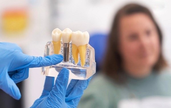 Dental Implants Treatment