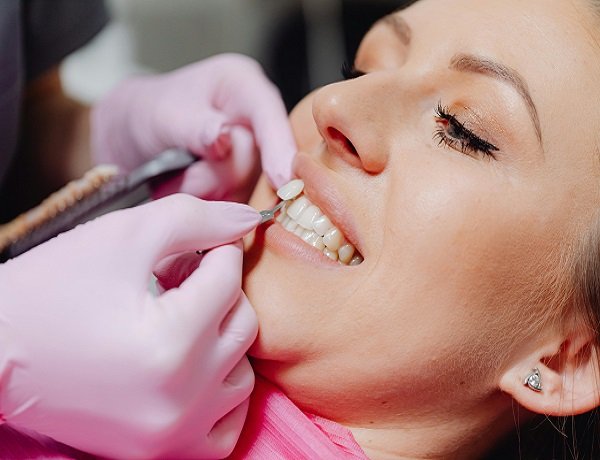 Porcelain Veneers Smile Makeover