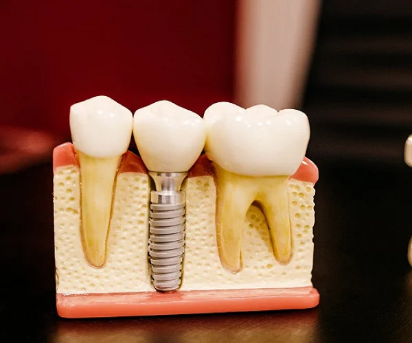 Dental-Implants